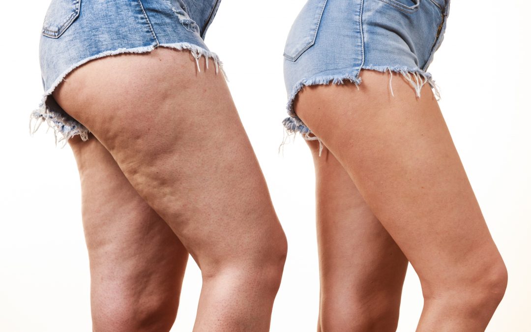 Cellulite – wie entstehen sie und wie können sie behandelt werden?