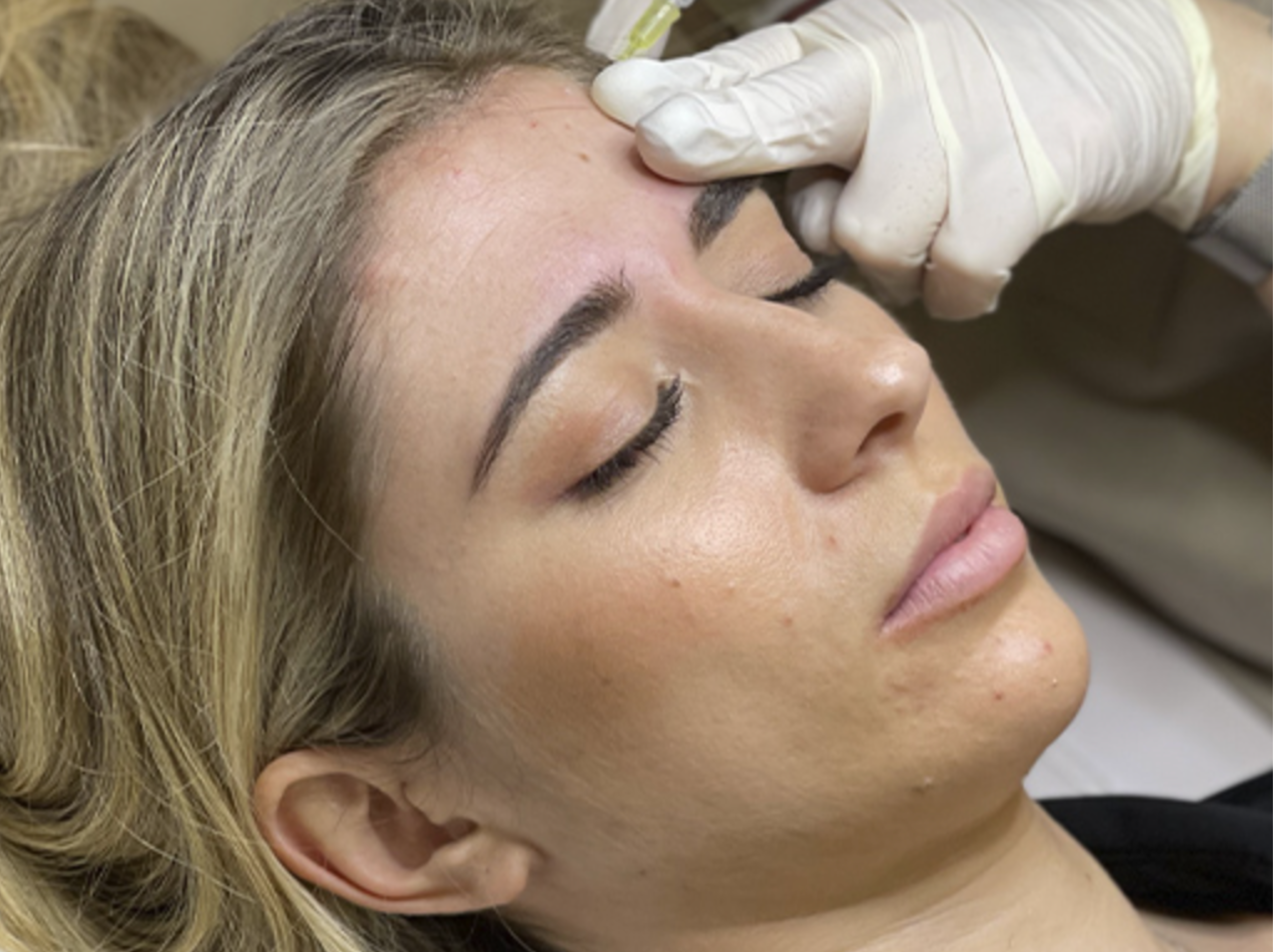 Ästhetische Medizin – Augenbrauenlifting